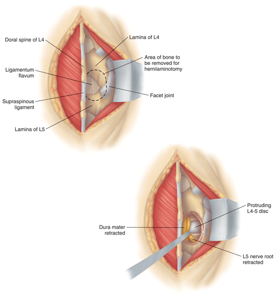 Lumbar discectomy